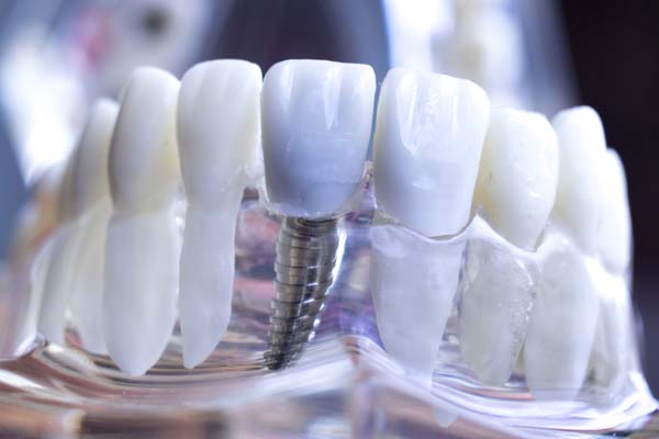 What Happens After Dental Implants Are Placed?